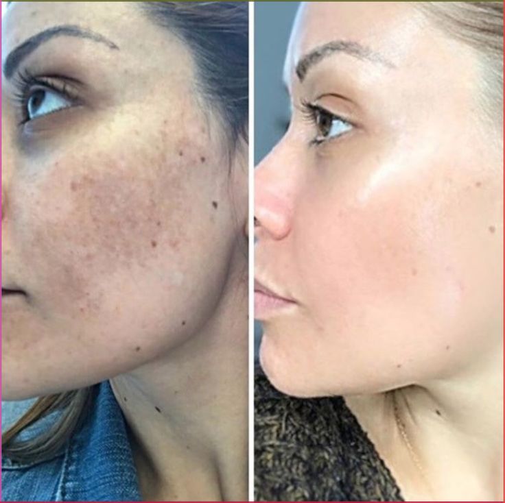 Kojic Acid Brightening Soap