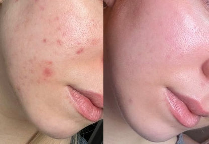 Anti Acne Brightening Soap