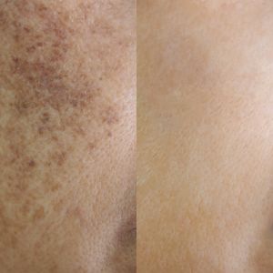 Kojic Acid Brightening Soap