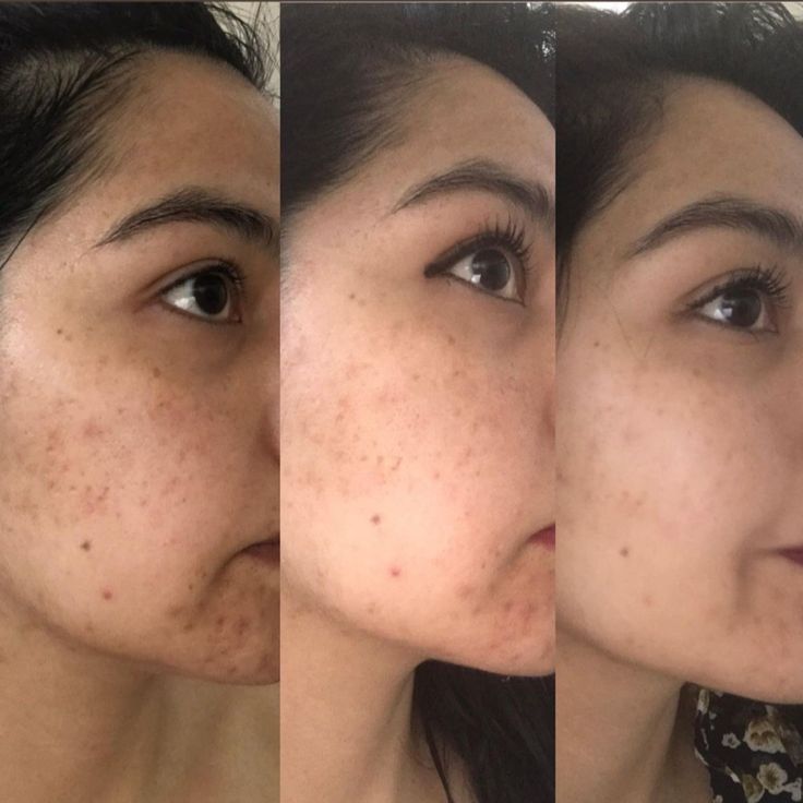 Kojic Acid Brightening Soap