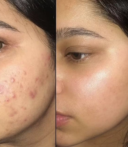 Anti Acne Brightening Soap